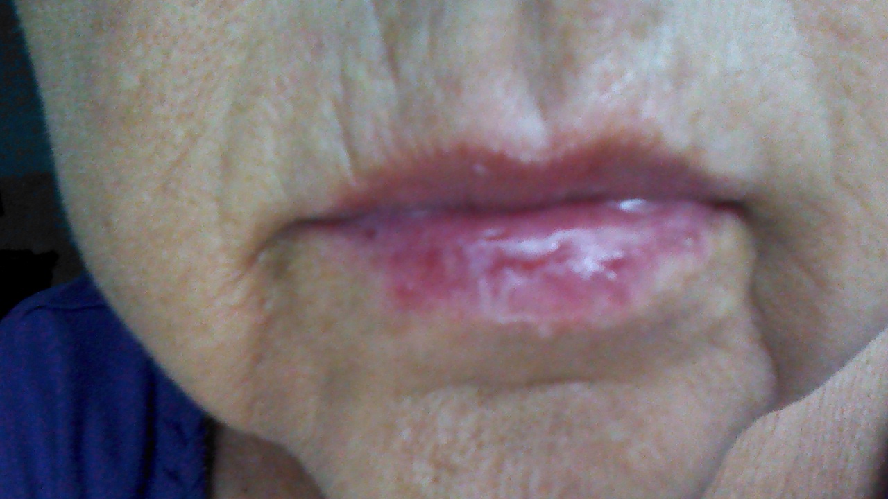 lip-won-t-heal-mouth-conditions-condition-our-health