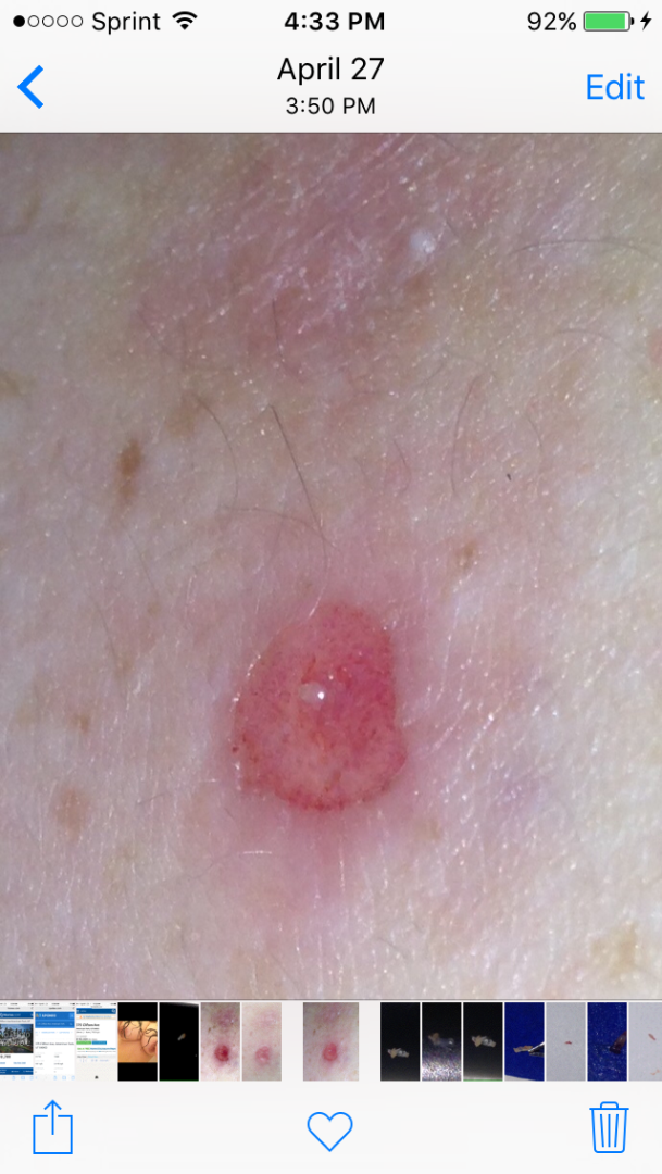 Strange white rice size growths in skin ulcer bed Skin Lesion