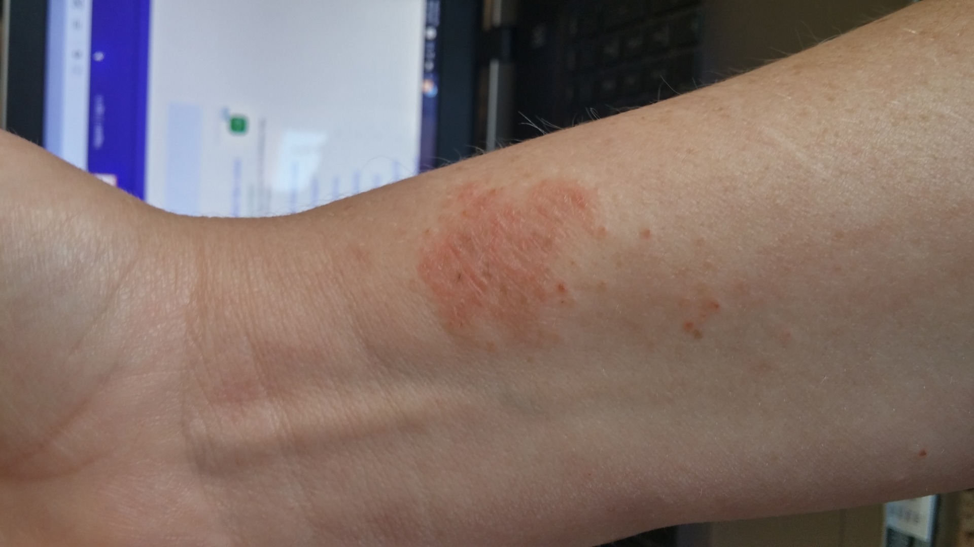 100 BIZARRE INTENSE Itching Rash Hive Like Red Patches on Legs, Arms